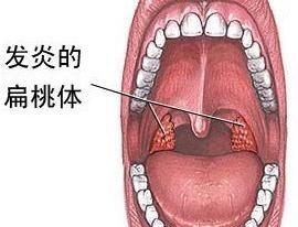 儿童扁桃体肿大有什么好治疗方法图2