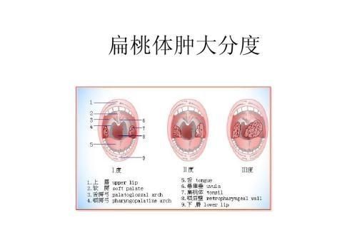 儿童扁桃体肿大有什么好治疗方法图3