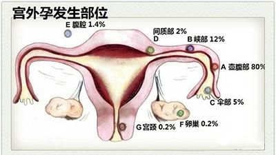 准妈妈必知：宫外孕的6大早期症状