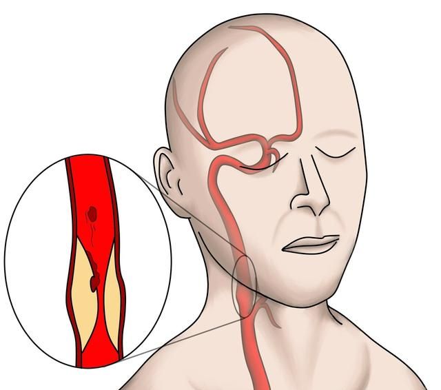 脖子上的吻痕，要避开一处要害，太惹眼6个技巧助你“活血化瘀”