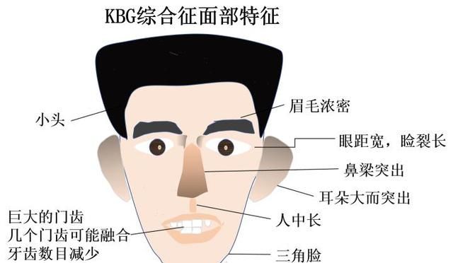 健康夫妻两次怀孕均是罕见病患儿？生殖腺嵌合了解一下